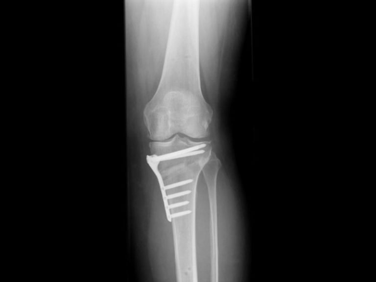 Osteotomia Do Joelho Dr Jo O Guilherme Geist Cirurgia Do Joelho